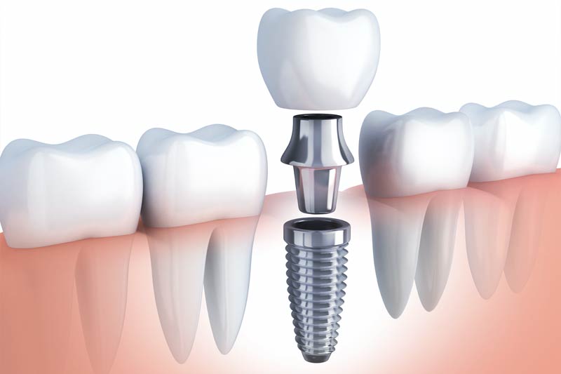 Implants Dentist in Gilbert and Queen Creek