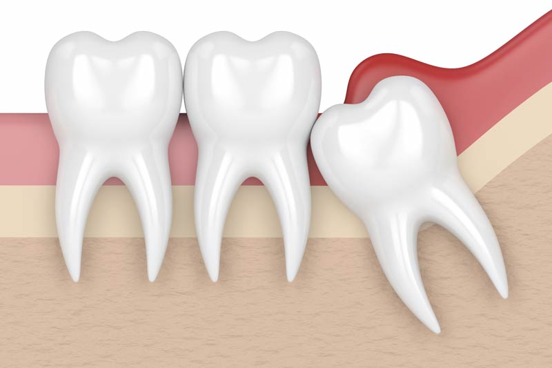 Wisdom Tooth Removal in Gilbert and Queen Creek